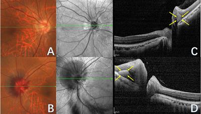 Peripapillary hyper-reflective ovoid mass-like structures (PHOMS): clinical significance, associations, and prognostic implications in ophthalmic conditions